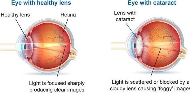 about-cataract