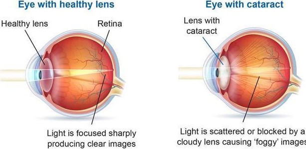 about-cataract about-cataract