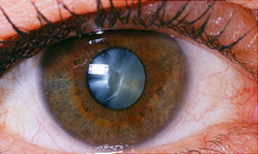 cataract-service