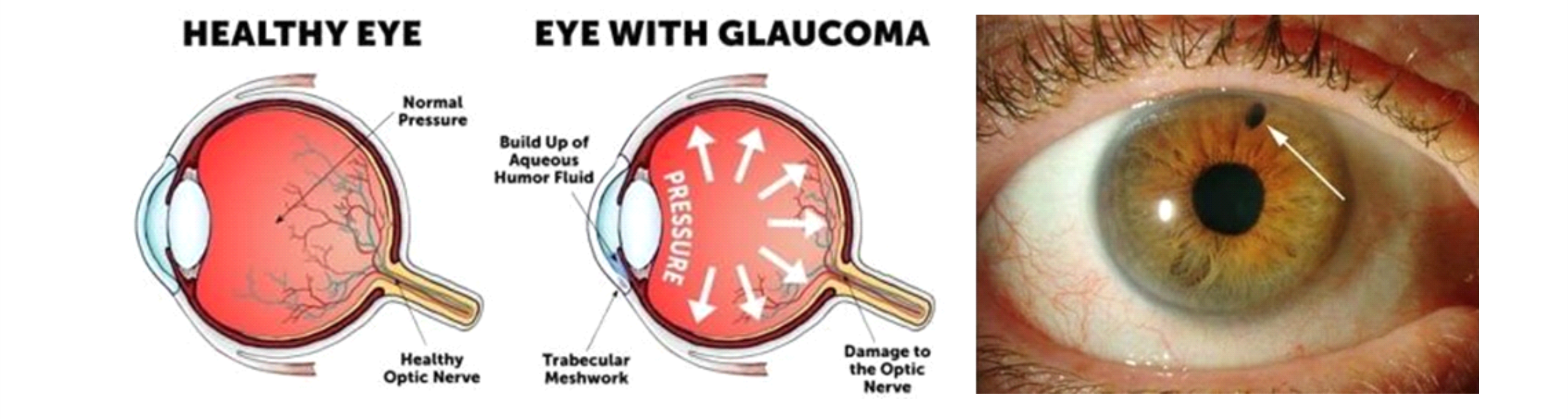 glaucoma-eye