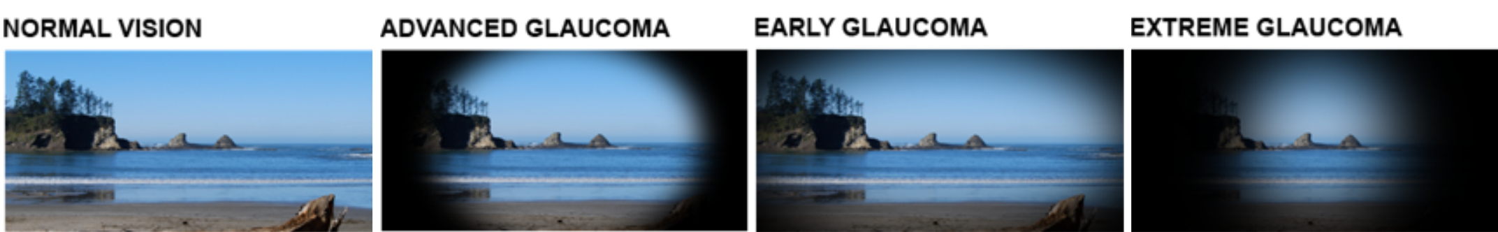 normal-vs-glaucoma